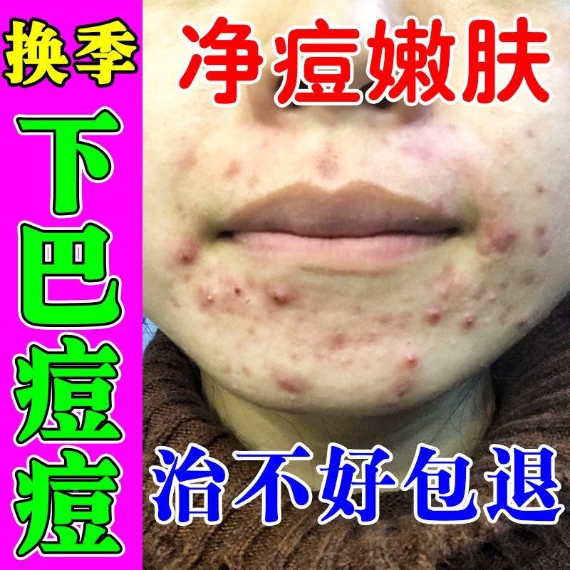 下巴痘痘内调下巴反复长硬块痘痘红肿脓包内分泌失调淋巴痘腮边痘