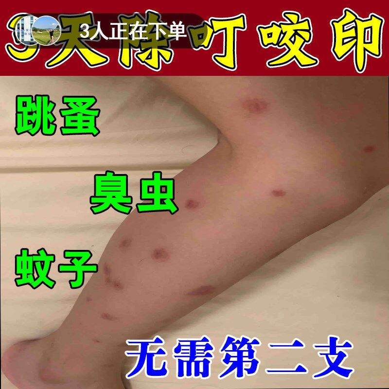 去除淡化疤印黑印痘印黑色素沉淀沉着修复疤痕除疤蚊虫叮咬印抑菌