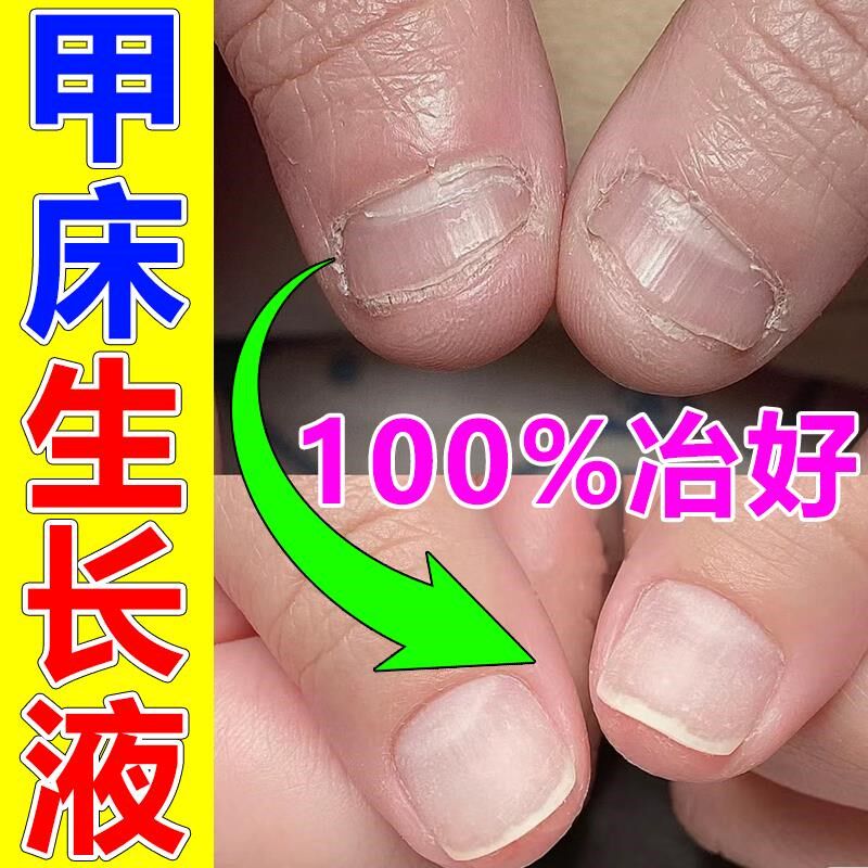 甲床修覆生长液指甲受损萎缩甲肉分离空甲断裂竖纹护甲油甲床增长