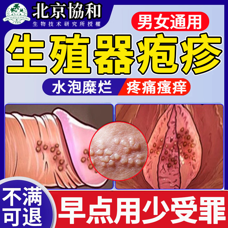 【北京协和】生殖器疱疹喷剂药膏