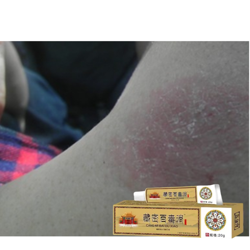 脖子长癣脖子红斑癣脖子上红痒皮肤过敏发红脖子皮肤干燥痒起皮