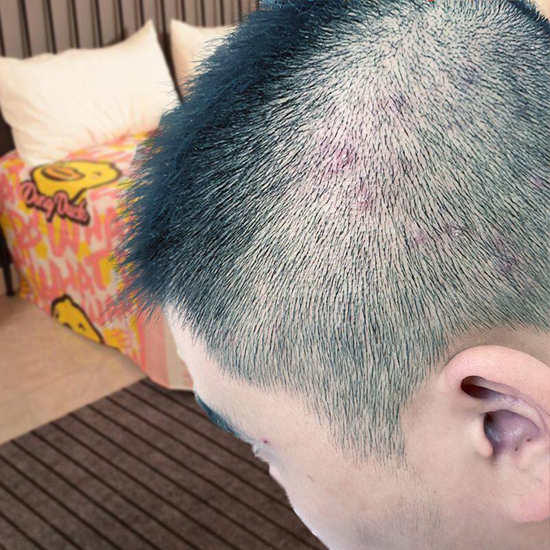 头上起红疙瘩脓包痘痘毛囊炎头皮痒头上长毒疙瘩又疼又痒掉头屑多