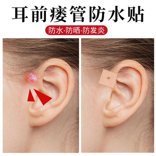 耳前瘘管防水贴护耳朵耳前瘘管防进水成人儿童洗头洗澡耳罩