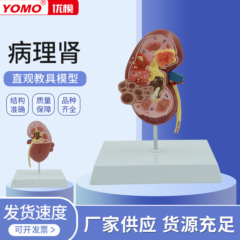 人体肾脏结构病变内脏器官解剖模型泌尿科肾小球肾单位教学