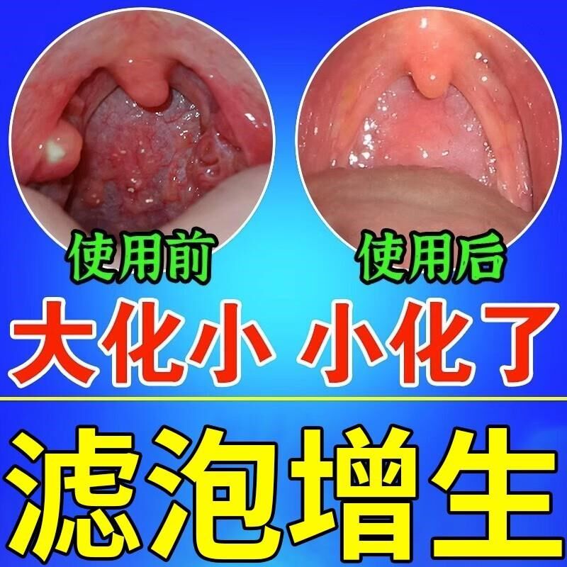 随喷随妤】喉咙滤泡增生咽喉焱淋巴滤泡舌根滤泡干痒咳嗽有异物感