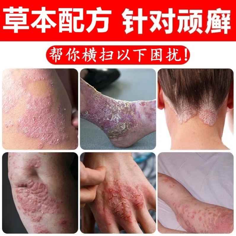 根治专用老人皮肤干燥瘙痒全身中医紫椒癣酊皮肤病
