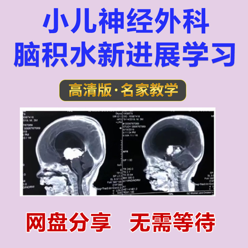 小儿神经外科脑积水新进展学习儿童脑细胞瘤神经系统肿瘤术中核磁