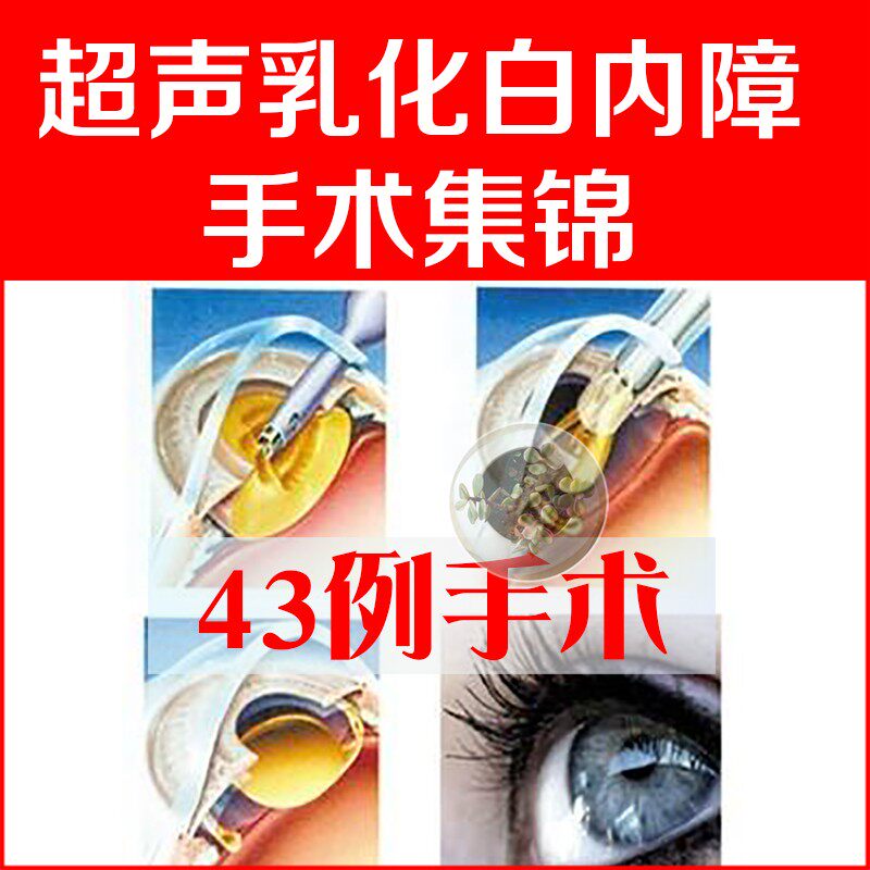 超声乳化白的内的障手术高清视频带讲解眼科晶状体植入虹膜切除