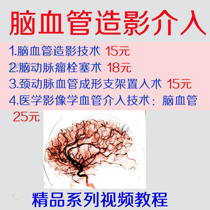 脑血造影技治支术脉动栓塞影像