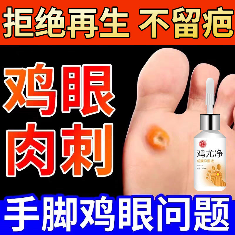 鸡眼药水鸡茧眼膏贴鸡尤净脚底脚趾老茧肉刺趾跖疣抑菌顽祛趾正品