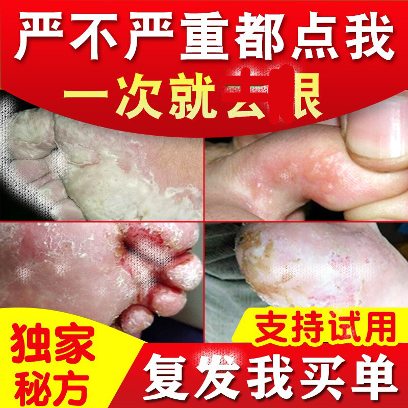 黄铍医脚气止痒脱皮杀菌真菌感染根去烂脚丫脚趾缝水泡脚气喷剂