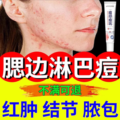 清痘消痕膏玫瑰痤疮痘痘