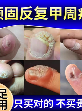 甲周疣甲下疣专用去儿童手指长疣寻常疣瘊子祛除去除硬皮神器XG