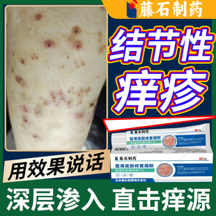 结节性痒疹皮肤湿疹顽固红硬疙瘩红斑专用止痒药房同款YZ