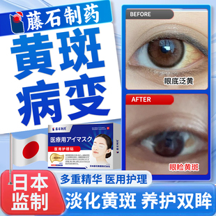 眼底黄斑病变眼贴可搭眼白发黄眼睑裂斑清澈去黄眼睛浑浊YZ