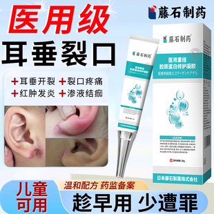 儿童耳垂开裂耳朵耳后烂耳根裂口裂开割耳疮湿疹发炎药房同售膏VQ