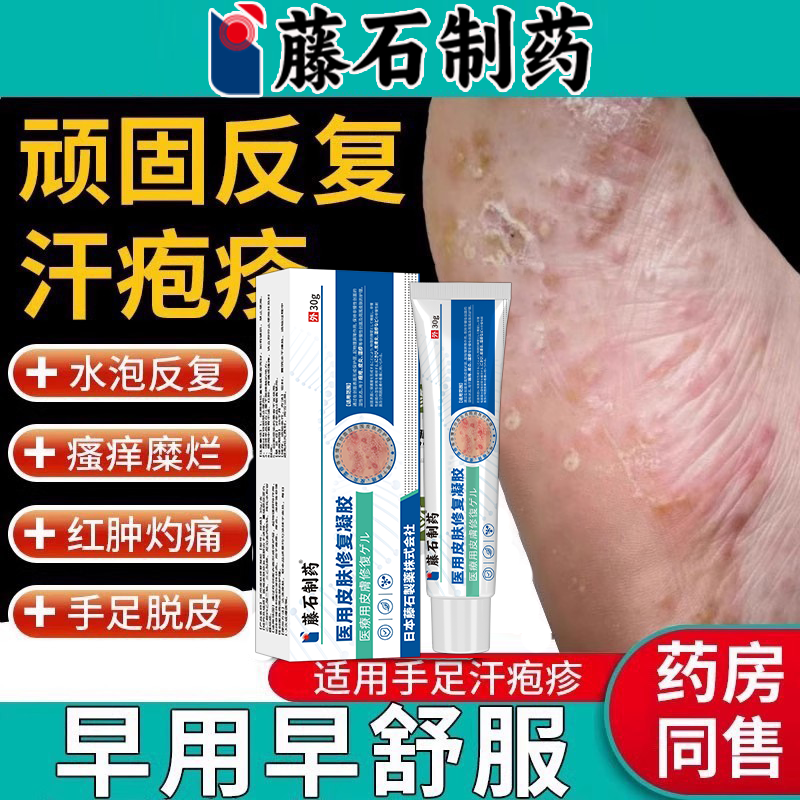 医用级别脚上汗疱疹止痒专用膏