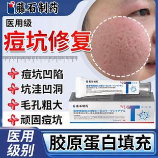 祛痘坑凹洞修复膏填充再生痘印女男士医用型胶原蛋白搭生长因子TU