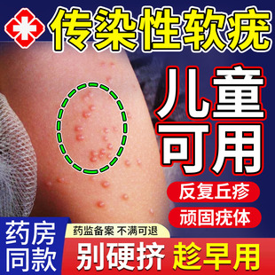 传染性软疣儿童病毒性水猴子瘊子软尤疣瘊肉粒夹子去除TU