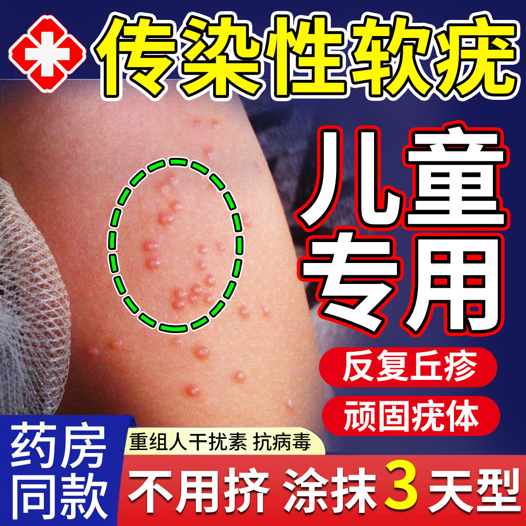 传染性软疣儿童病毒性水猴子瘊子软尤疣瘊肉粒夹子去除可搭药膏tu