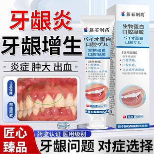 牙龈增生肿痛消炎牙周炎专用牙疼牙龈脓包出血红肿药房同款牙膏HT