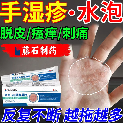 手上起小水泡汗状疱疹干裂脱皮