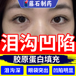去泪沟眼部眼窝凹陷修复填充胶原蛋白神器贴眼袋面部法令纹去除WQ