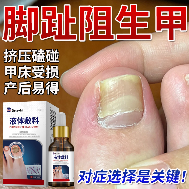 大脚趾阻生甲修复液--产后可用图片