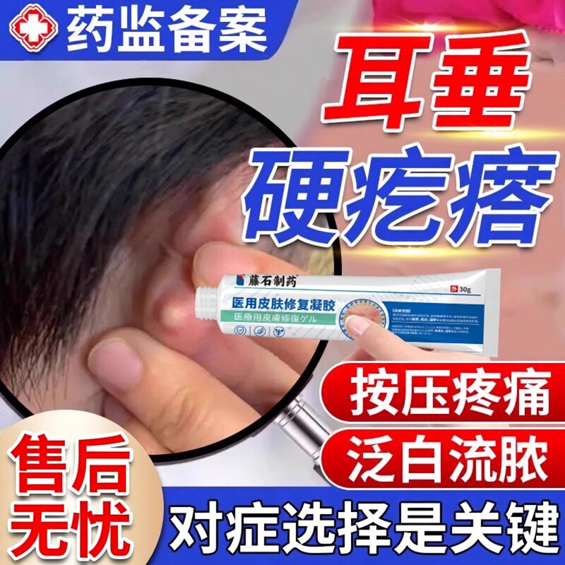 耳垂耳朵后面长疙瘩粉瘤皮脂腺囊肿疖肿硬块拔毒火疖子敷料贴膏VQ