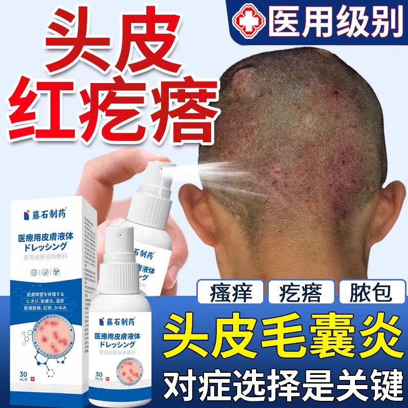 头上后脑勺长痘痘头皮痒起红硬疙瘩溢脂性毛囊炎净洗发水喷雾剂VQ