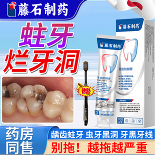儿童蛀牙牙洞清理牙虫的牙齿防龋凝胶去黑线黑渍牙窝沟药房同售DS