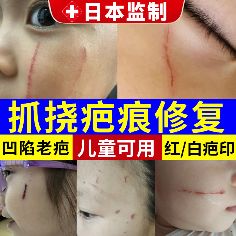 脸部抓痕淡化疤痕专用去疤膏