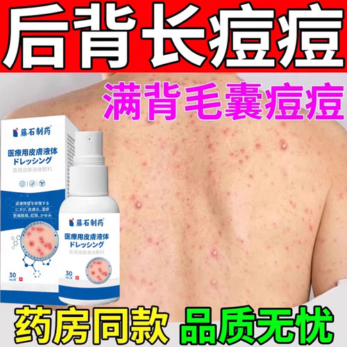 前胸后背毛囊炎长痘痘疙瘩喷雾剂