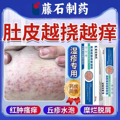 肚皮湿疹--肚子上长红斑瘙痒专用