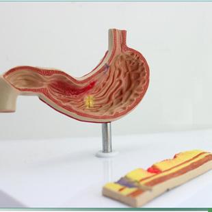 ENOVO正品胃溃疡模型胃穿孔胃病理模型消化科人体消Z化系统模型