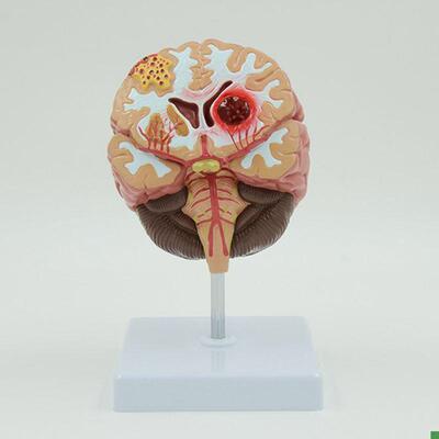 康泰模型脑血管卒中病理畸形动静脉破G裂出血中风神经系统医药促