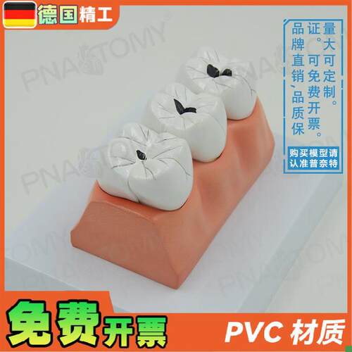 德国】牙科牙齿龋齿解剖分解模型口腔科牙O科病理蛀牙模型教学展
