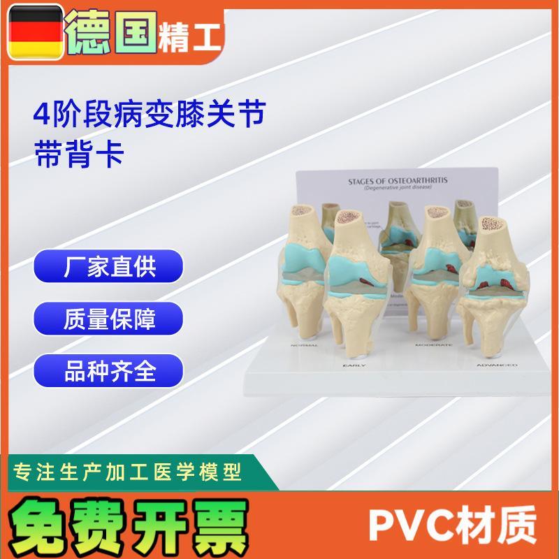 4阶段膝关节模型带背卡v病变膝关节模型骨科教学展示教具