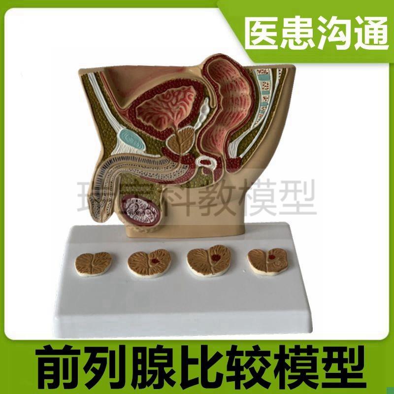 男性前列腺模型变大尿p道狭窄男科医患沟通临床医药礼品生殖泌尿