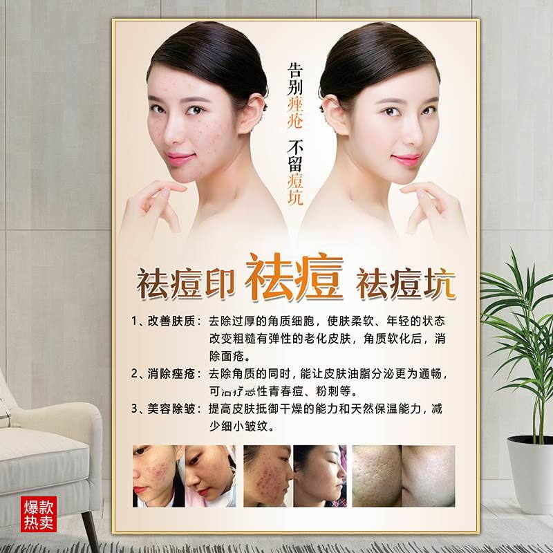 祛斑祛痘海报痤疮挂画点痣宣传图美白对比图图片美容院祛斑广告图
