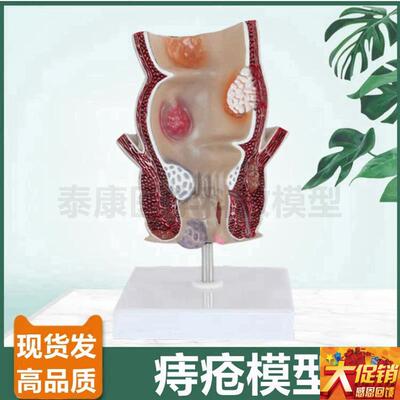 痔疮模型直肠肛管 肛肠科医院用 回肠盲肠K阑尾 病理大肠 医患沟