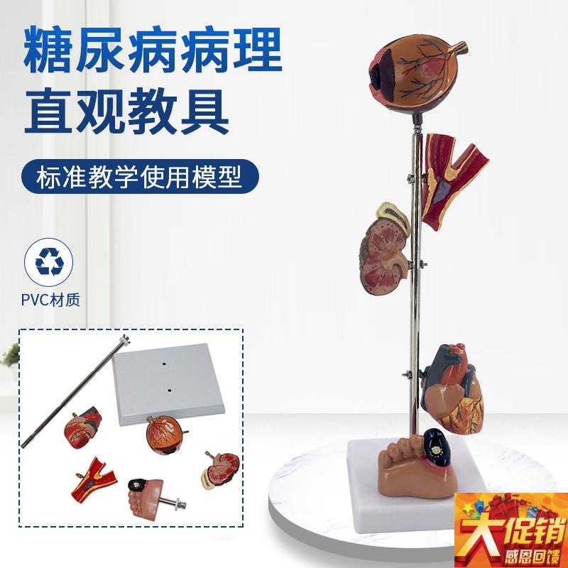 糖/尿病 高/血压模型 高血压病理变脑眼心脏肾脏血V管内脏模型G3