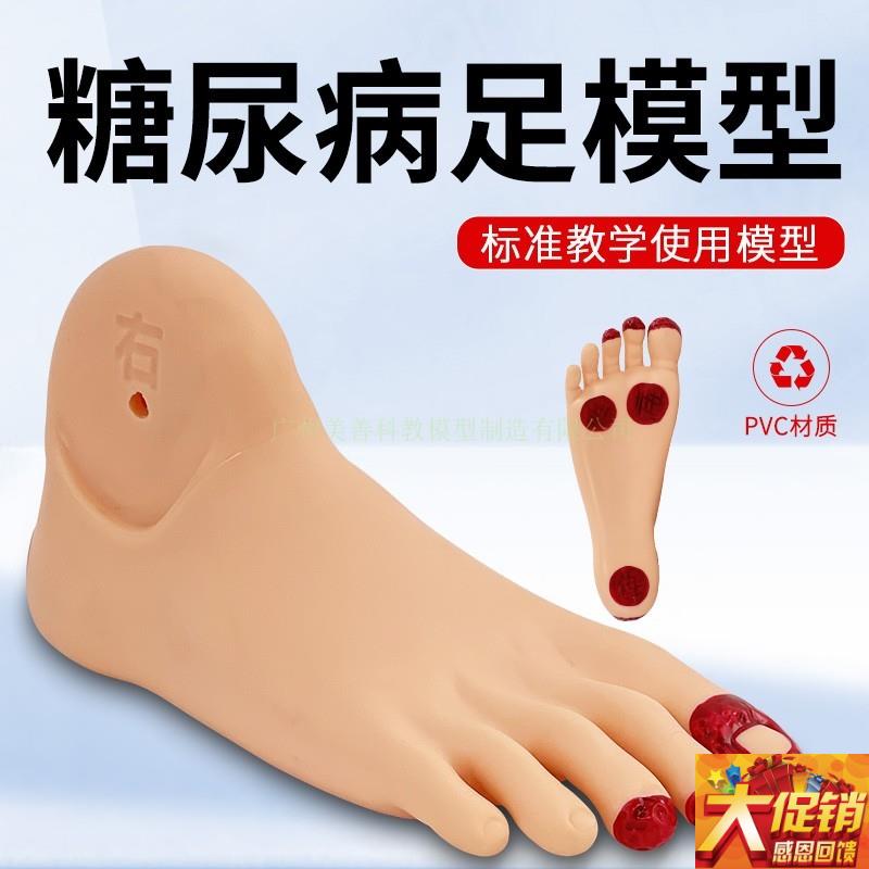 糖尿bing足护理模型s 老年人 足部病变护理模型 畸形脚模具