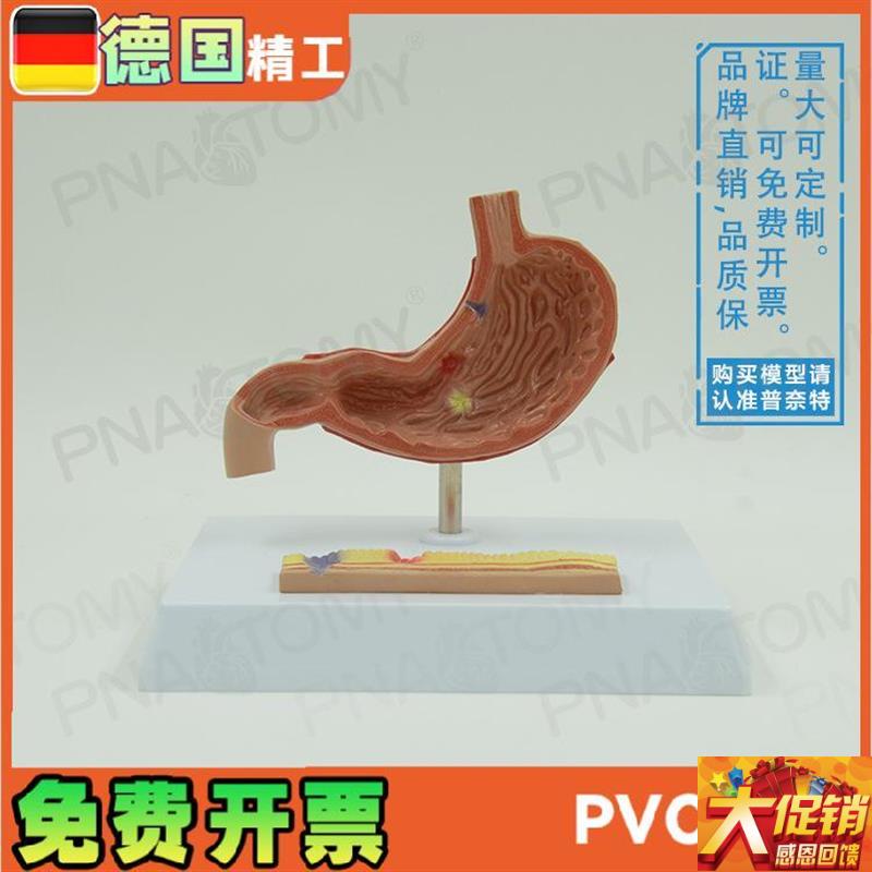 仿真人体胃解剖病理胃胃穿C 教学消化系统消化科标本