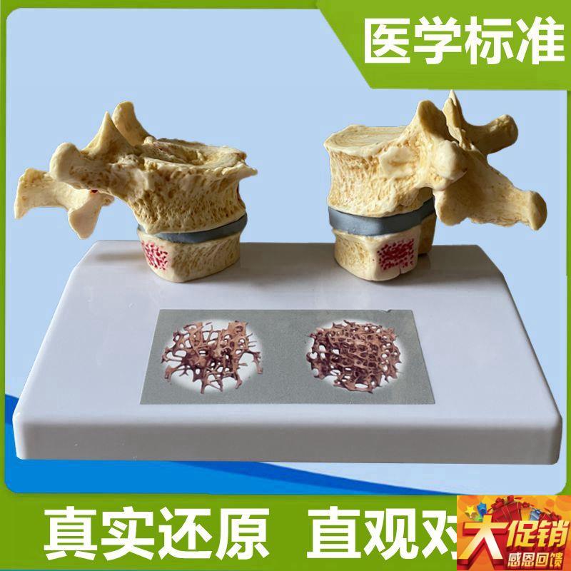 脊椎骨质疏松模型k老年人骨骼仿真股骨头密度腰椎变形劳损医患礼
