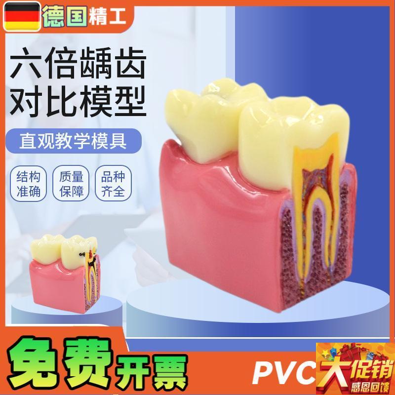德国】六倍龋齿对比模型 口腔牙齿模型口M腔教学蛀牙切面模型 牙
