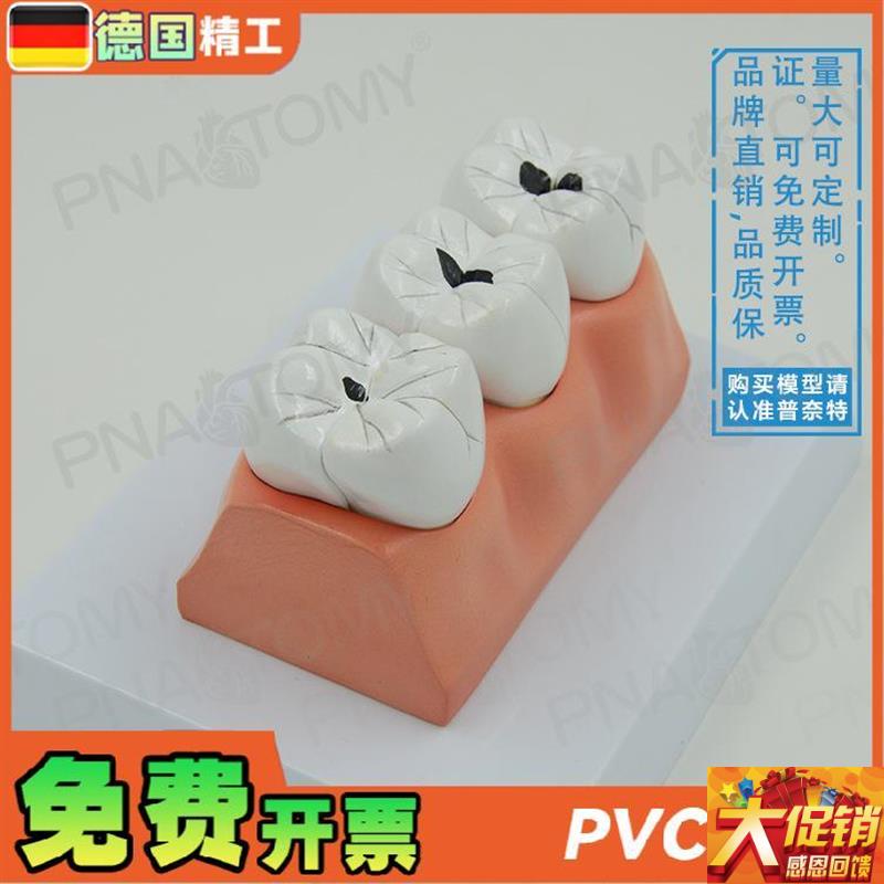 德国】牙科牙齿龋齿解剖分解模型口腔G科牙科病理蛀牙模型 教学展