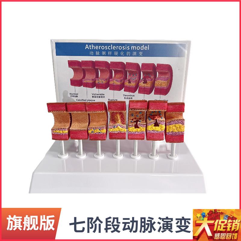 动脉粥样硬化模型血管血栓栓塞模型动H脉血管人体医用医学教学教