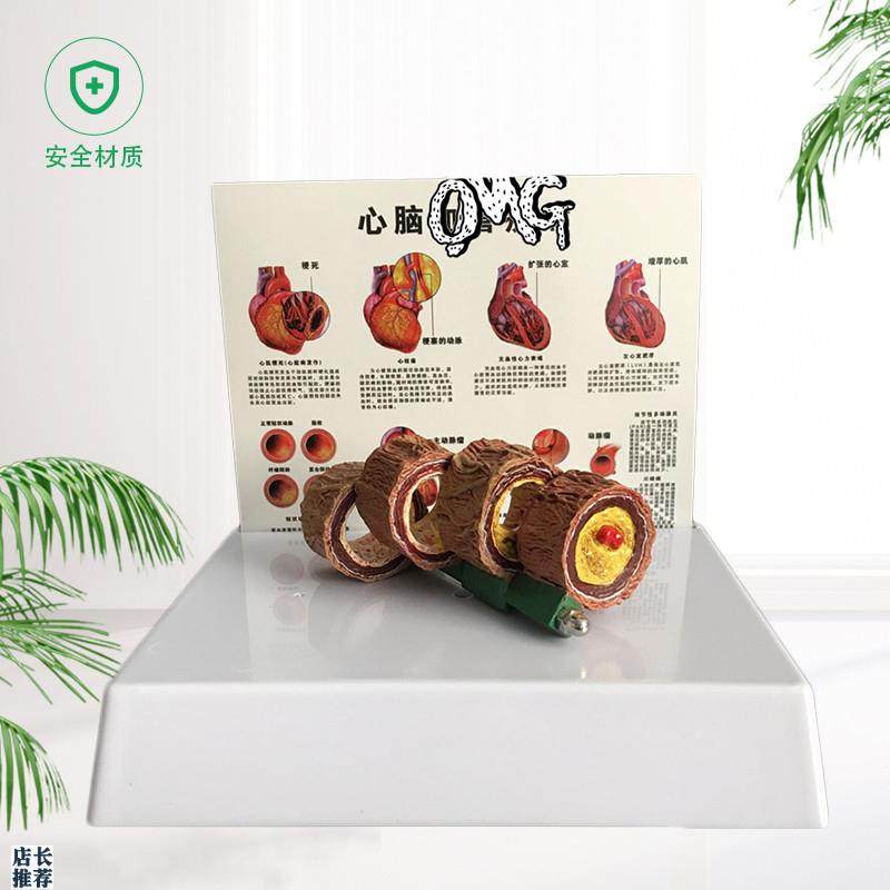 教学仿真b血管模型活动血管阻塞模型血栓病变标本4阶段性动脉O硬