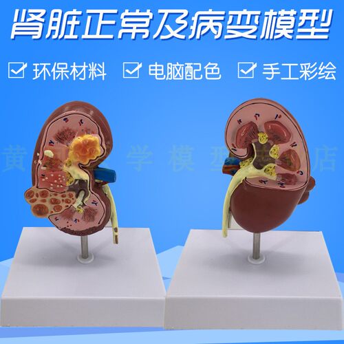 人体肾脏病变解i剖模型 病理肾jie石肾 泌尿科 医学人体肾脏模型